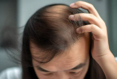 Jangan Remehkan Kondisi Rambut Rontok, Ternyata Bisa Bahaya Untuk Kesehatan Rambut, Ini 3 Cara Alami Mengatasi