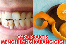 Selamat Tinggal Karang Gigi! Ini 5 Cara Menghilangkannya, Tanpa Biaya dan Praktis